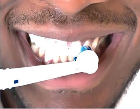 How Teeth Whitening Products Can Damage Your Teeth Meridian Hospitals
