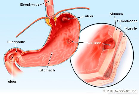 peptic-ulcer.jpg